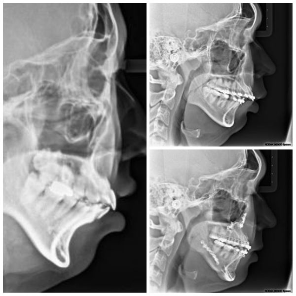 무턱을 동반한 심한 수면무호흡 환자의 영상(좌). 하악 후퇴증 환자의 턱교정 수술 후 기도의 확대(우). 사진=삼성서울병원